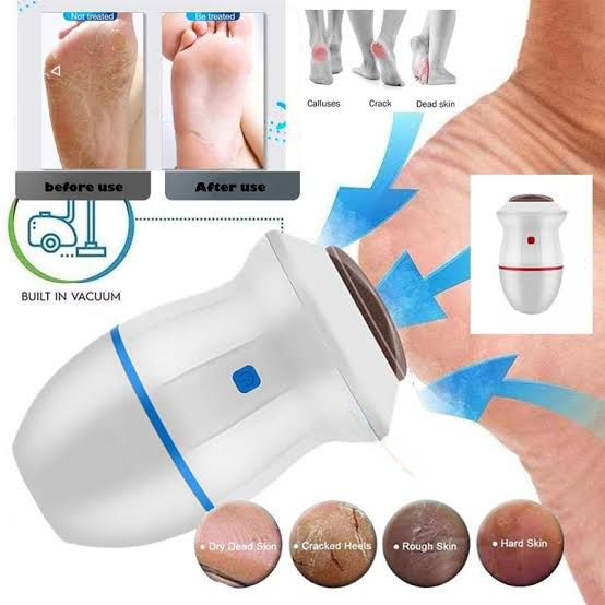 Electric Back Callus Remover with Built-In Vacuum